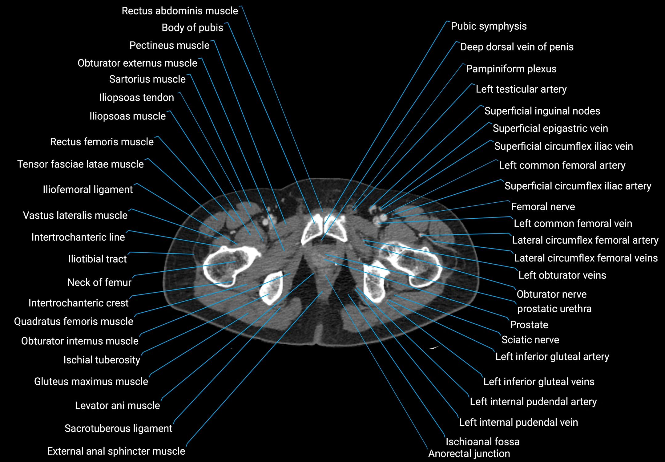 CT male pelvis axial cross sectional anatomy labelled radiology image -00200.webp